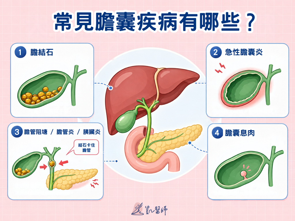 - 常見膽囊疾病示意圖,包含膽結石、急性膽囊炎、膽管阻塞與膽囊息肉