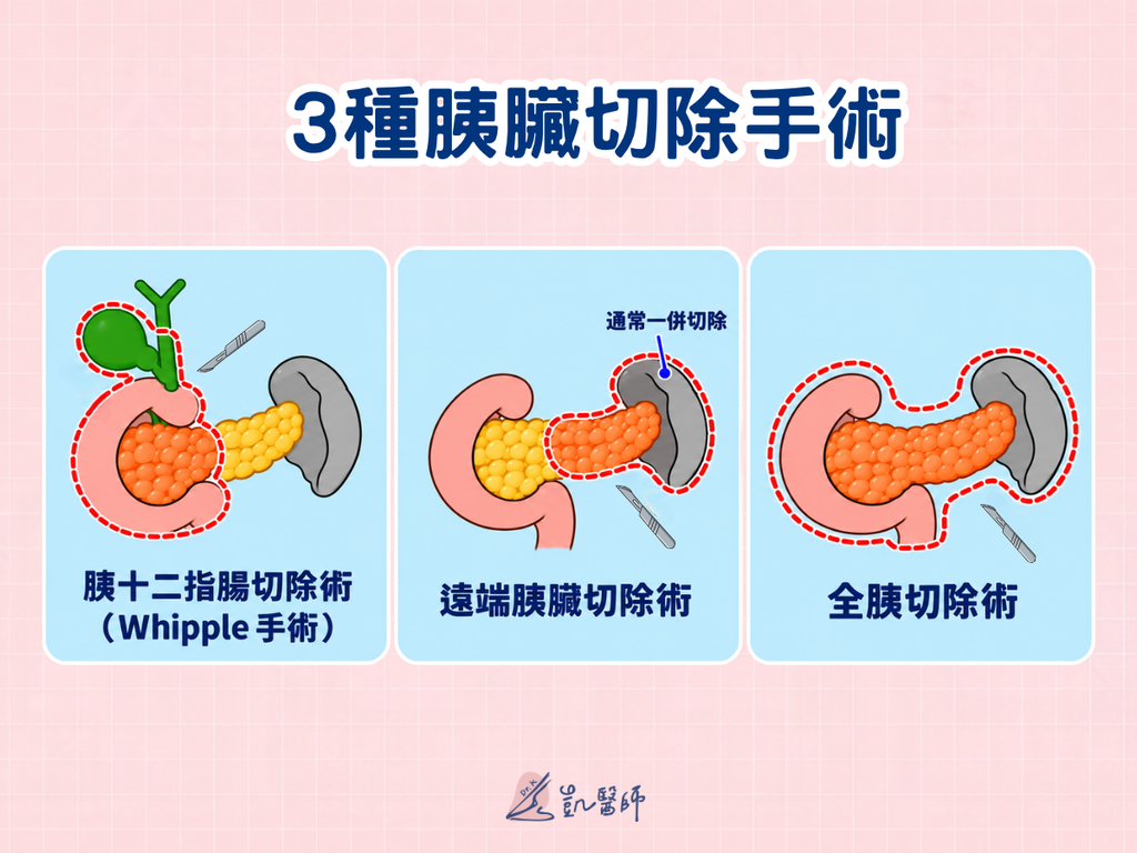 胰十二指腸切除術、遠端胰臟切除術與全胰切除術的範圍比較,紅色虛線標示各術式的切除部位。